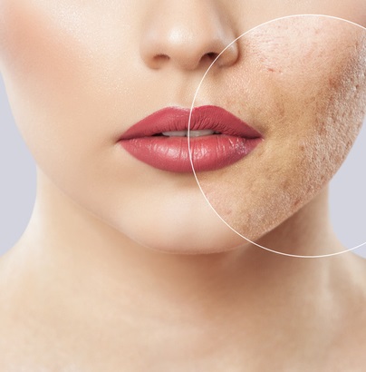 Preenchimento com acido hialurônico de cicatrizes de acne